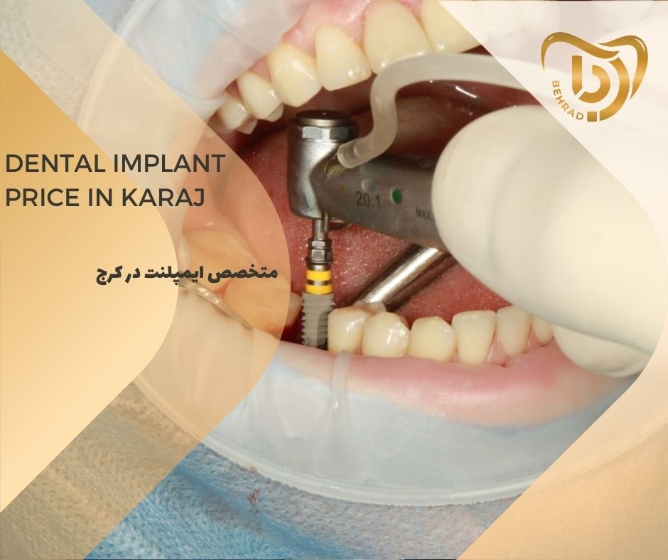 behrad-404-08-09 متخصص ایمپلنت در کرج