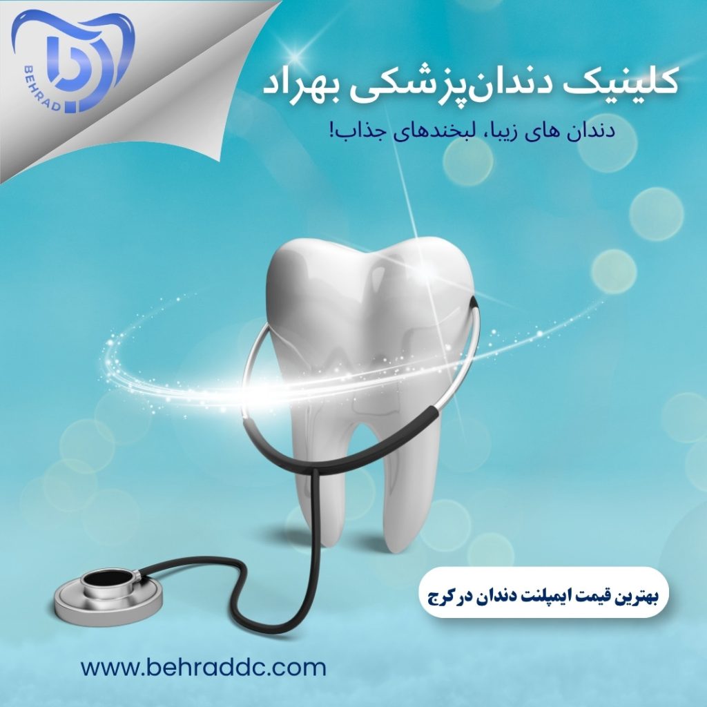 قیمت ایمپلنت دندان در کرج