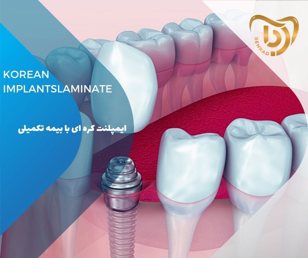 ایمپلنت کره‌ای با بیمه تکمیلی