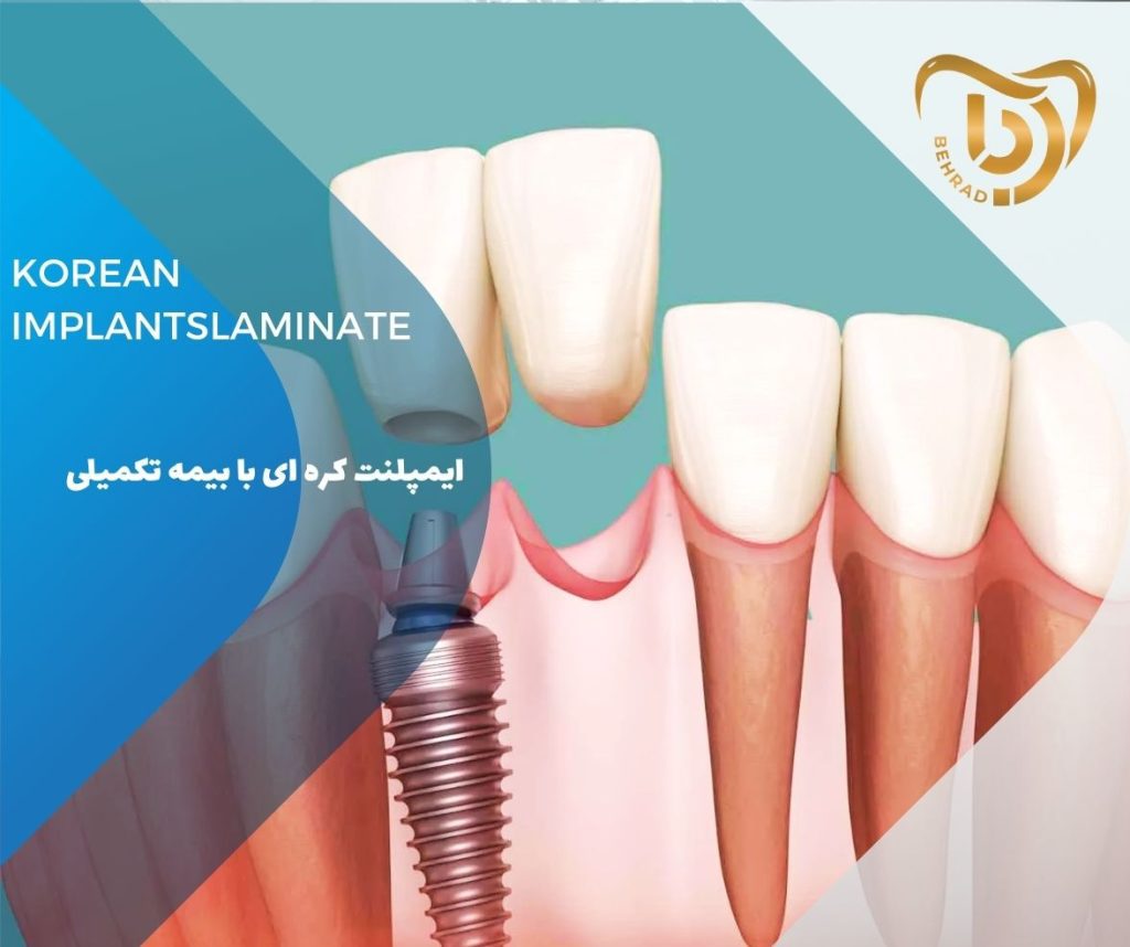 ایمپلنت کره‌ای با بیمه تکمیلی