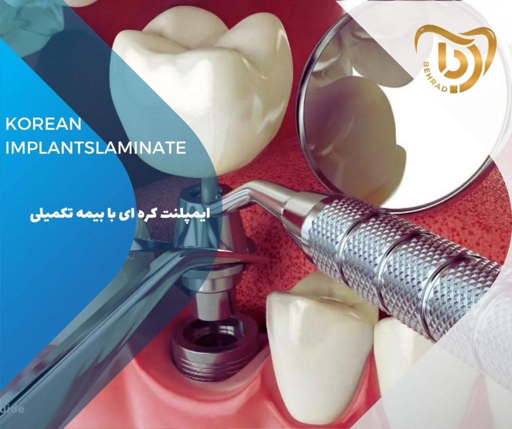 ایمپلنت کرهای با بیمه تکمیلی