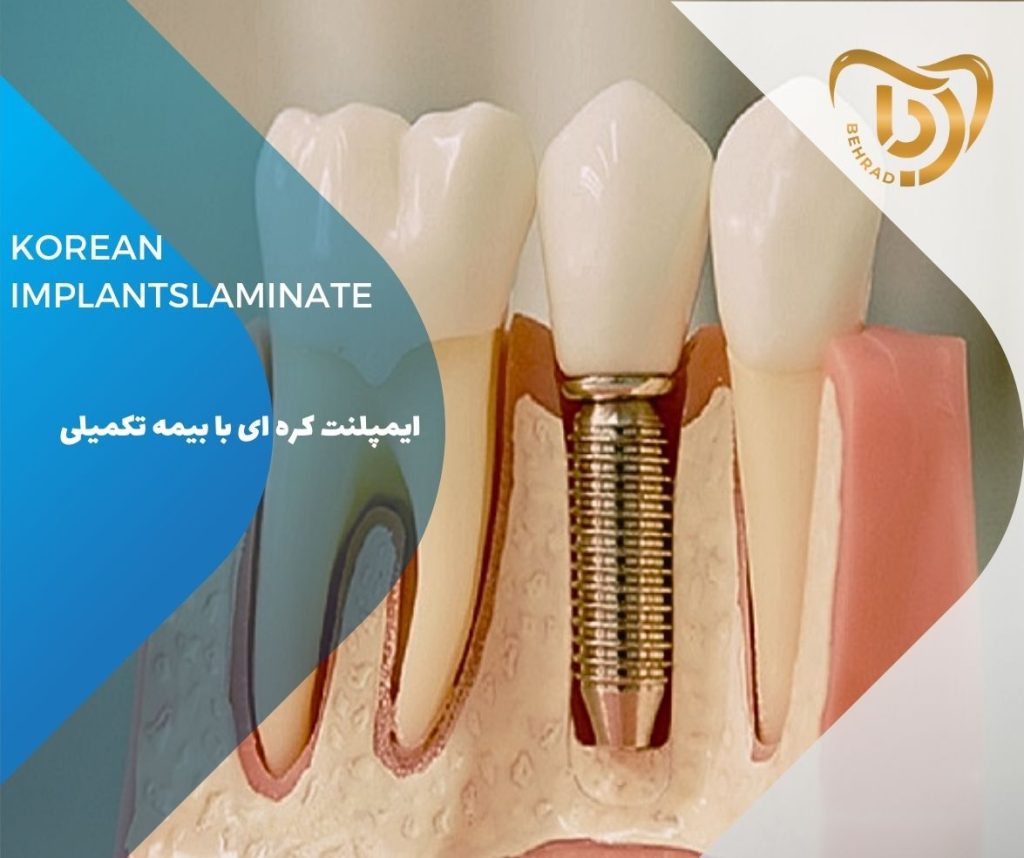 ایمپلنت کره‌ای با بیمه تکمیلی