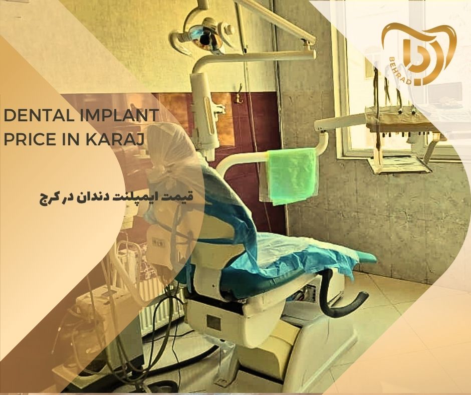 قیمت ایمپلنت دندان در کرج