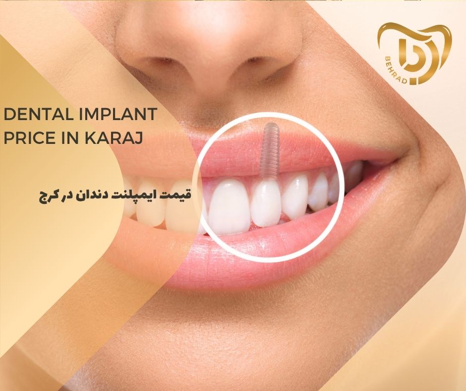قیمت ایمپلنت دندان در کرج