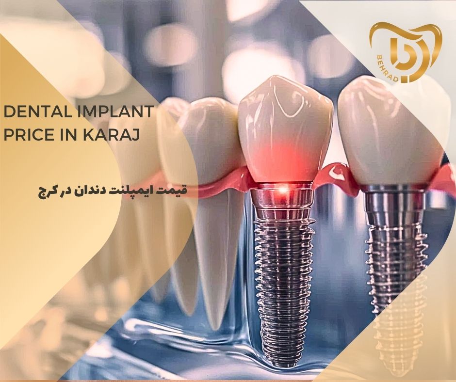 قیمت ایمپلنت دندان در کرج