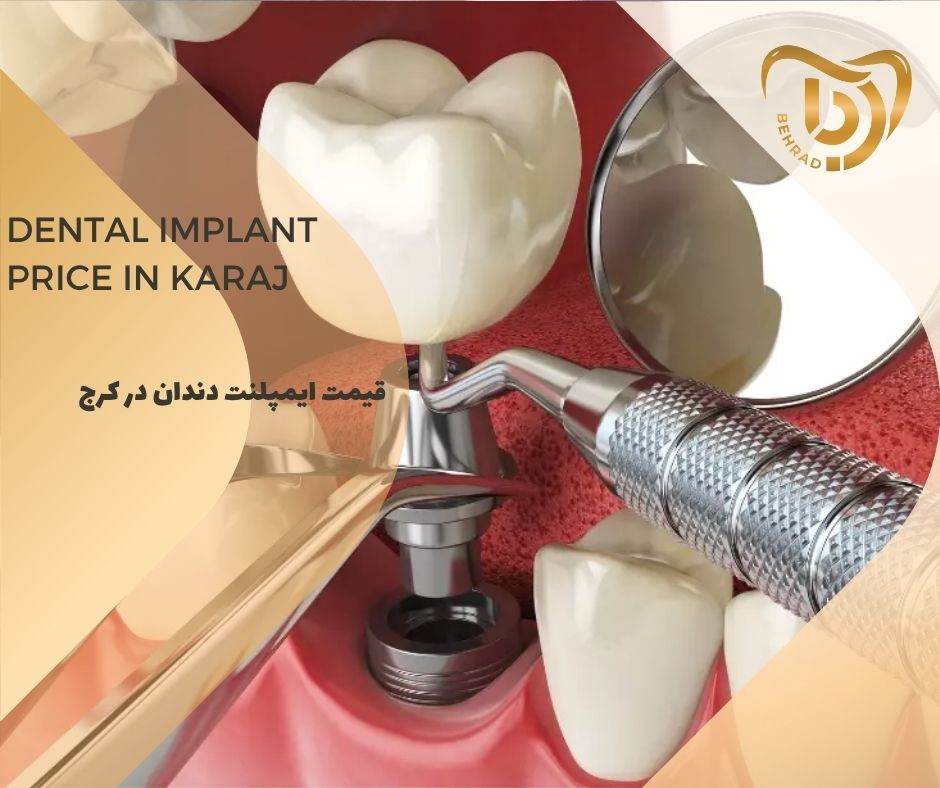 قیمت ایمپلنت دندان در کرج