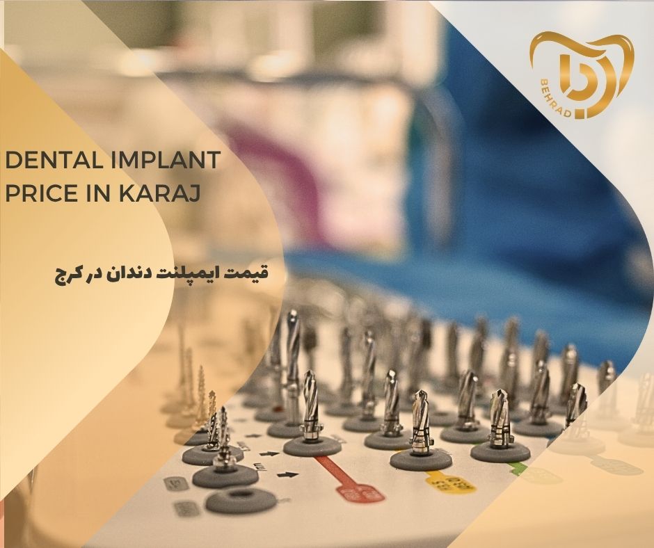 قیمت ایمپلنت دندان در کرج