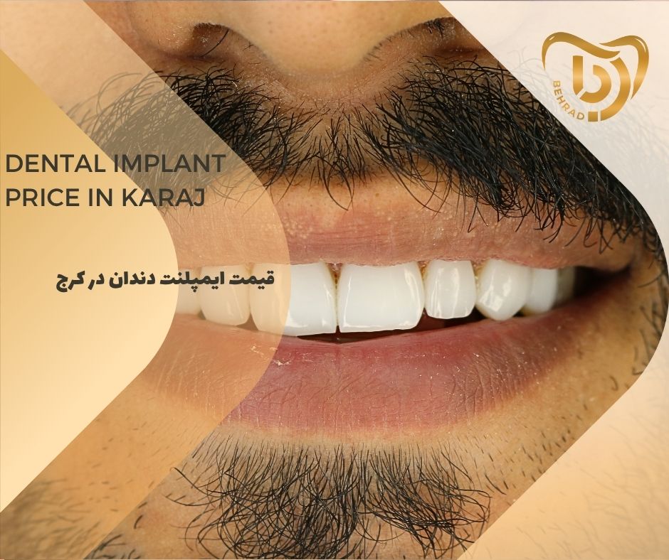 قیمت ایمپلنت دندان در کرج